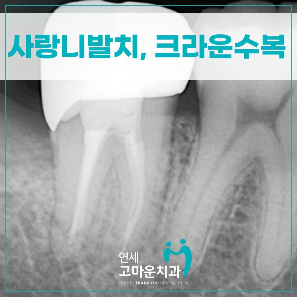 다정동충치치료