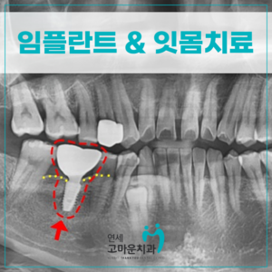 새롬동임플란트