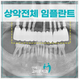 세종다정동임플란트