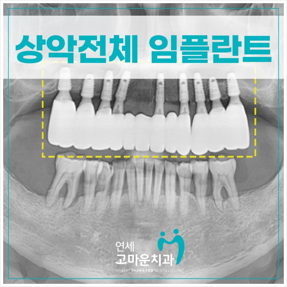 세종다정동임플란트