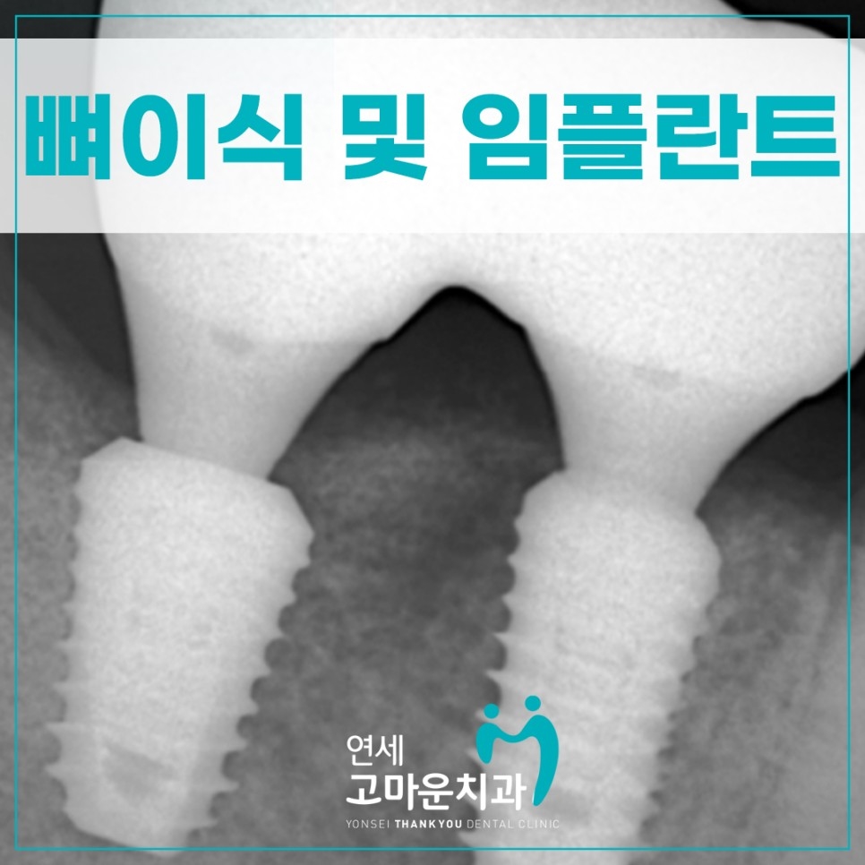 세종임플란트추천