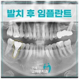 세종임플란트치과추천