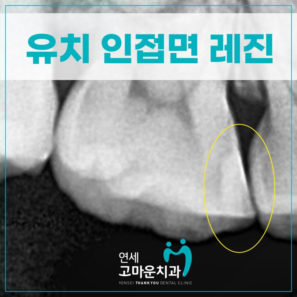 한솔동충치치료잘하는곳