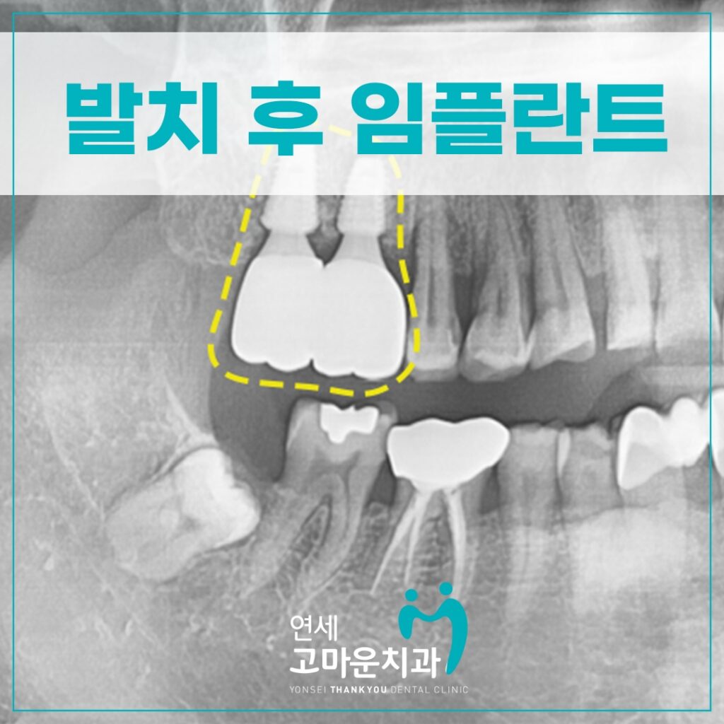새롬동임플란트추천