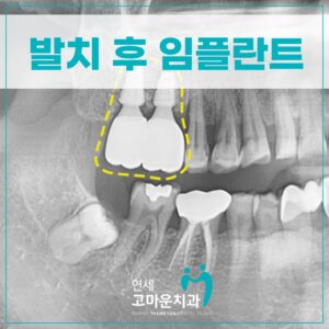 새롬동임플란트추천