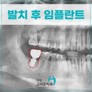 첫마을임플란트추천