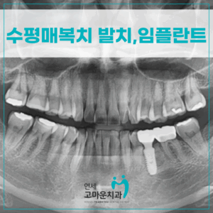 나성동임플란트추천1