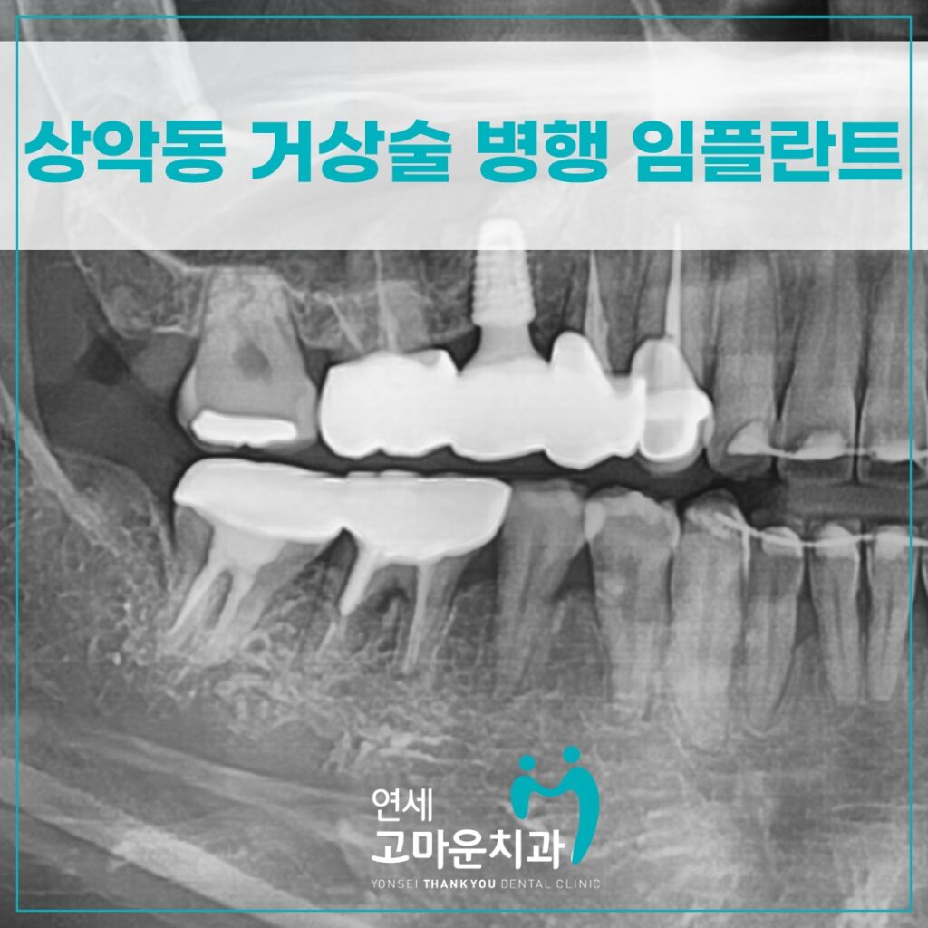 다정동임플란트추천