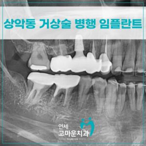다정동임플란트추천