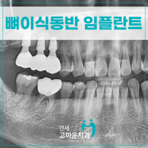 한솔동임플란트추천1