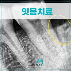 한솔동잇몸치료1